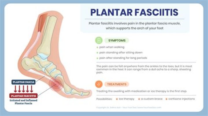 How plantar fasciitis occurs?