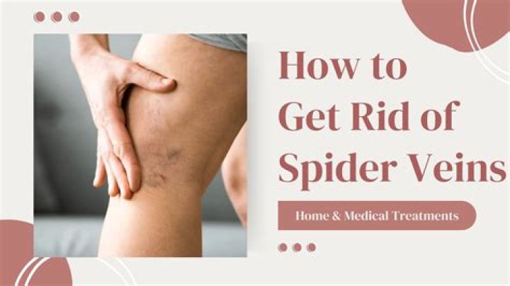 How to cure spider naevi?