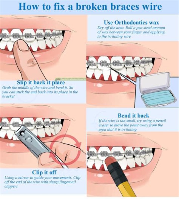 How to handle poking wires on braces?