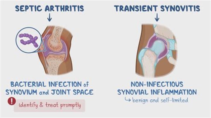 How to prevent synovitis?