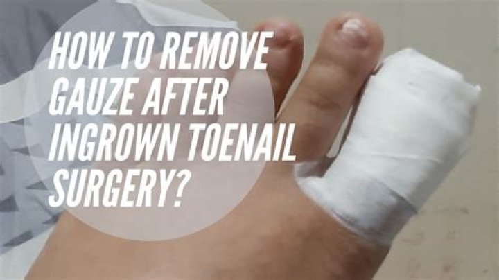 How to remove gauze?