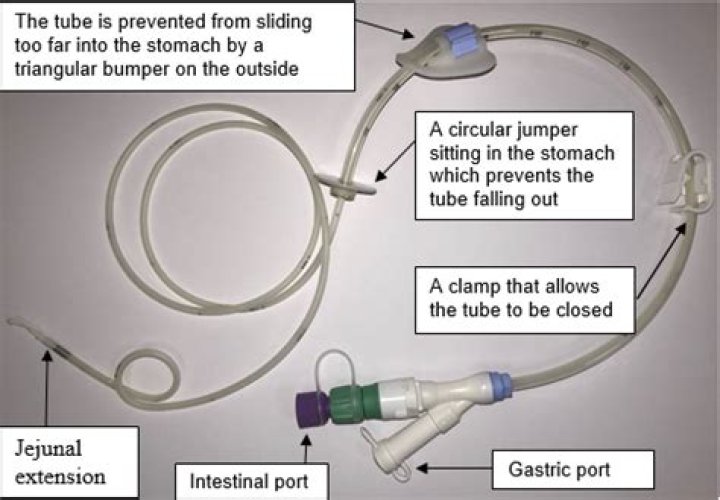 How to stop peg tube from leaking?