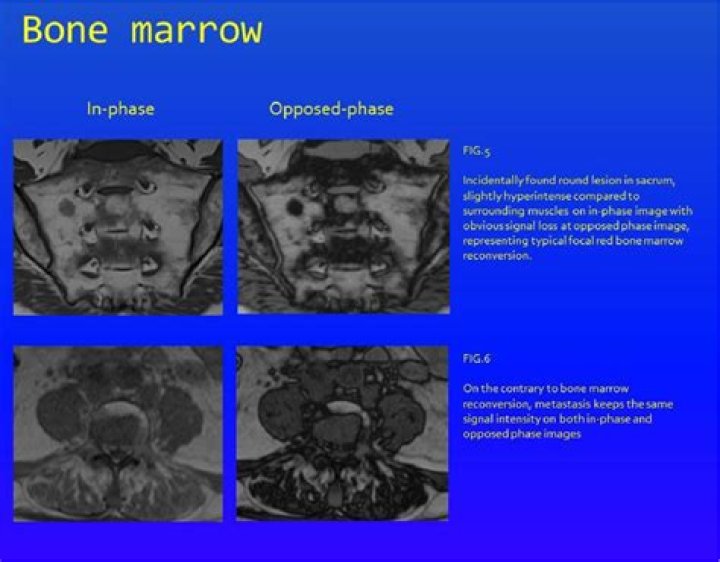 In opposed phase mri?