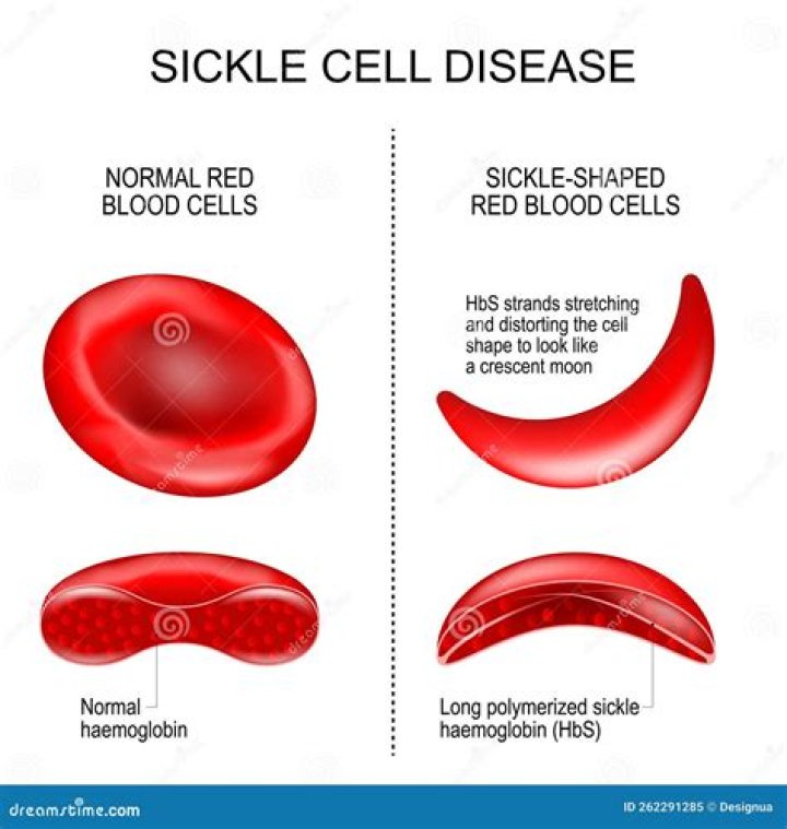 In sickle-cell disease the characteristic sickle-shaped cells are?