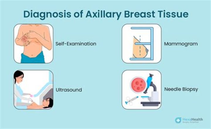 Is accessory breast tissue dangerous?