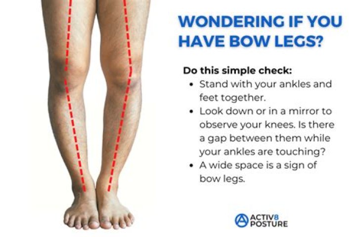 Is bow legged bad?
