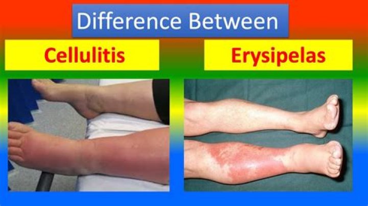 Is erysipelas or sinusitis?