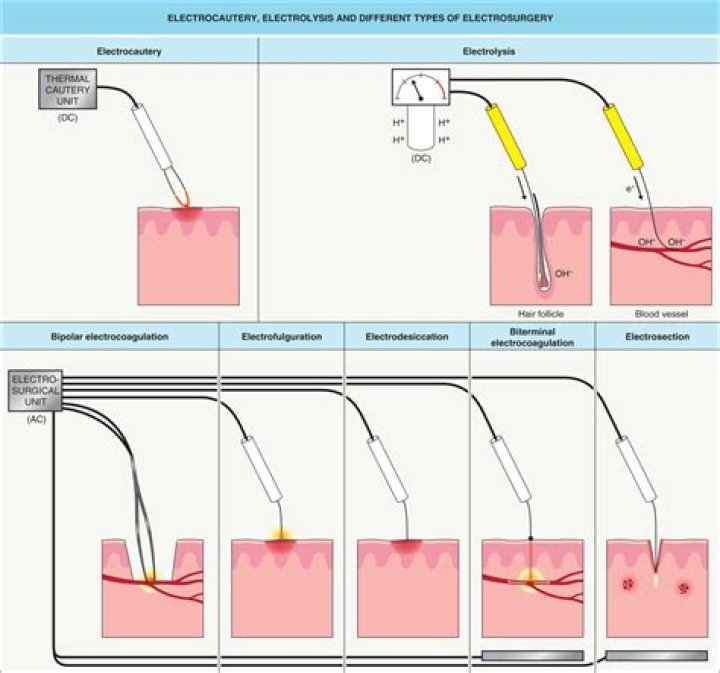 Is fulguration and electrocautery the same thing?