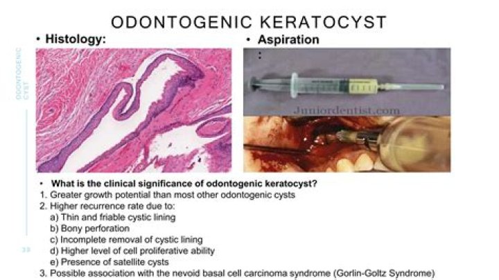Is odontogenic cysts dangerous?