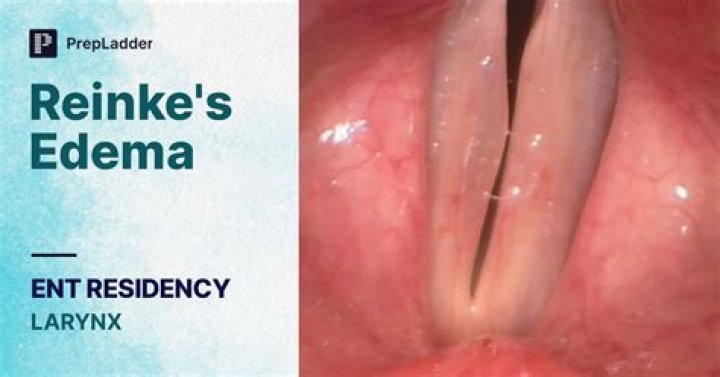 Is reinke's edema cancer?