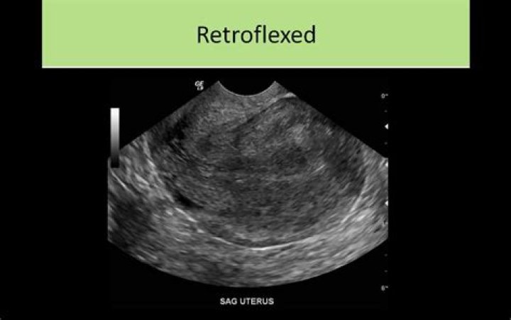 Is retroflexed uterus normal?