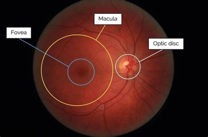 On ophthalmoscopic examination optic atrophy appears?