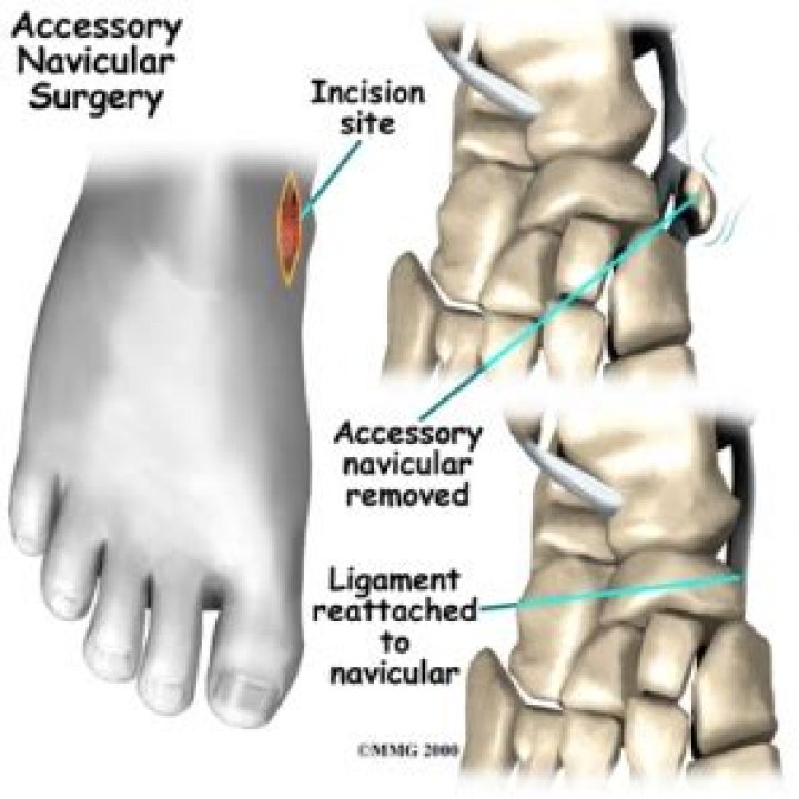 Should i get accessory navicular surgery?