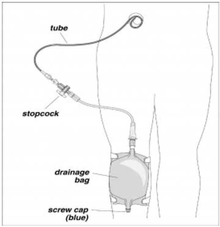 Should nephrostomy tube be flushed?