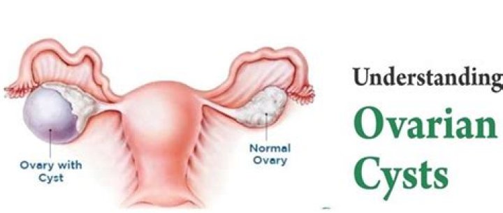 Should paraovarian cysts be removed?