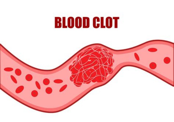 Were do blood clots form?