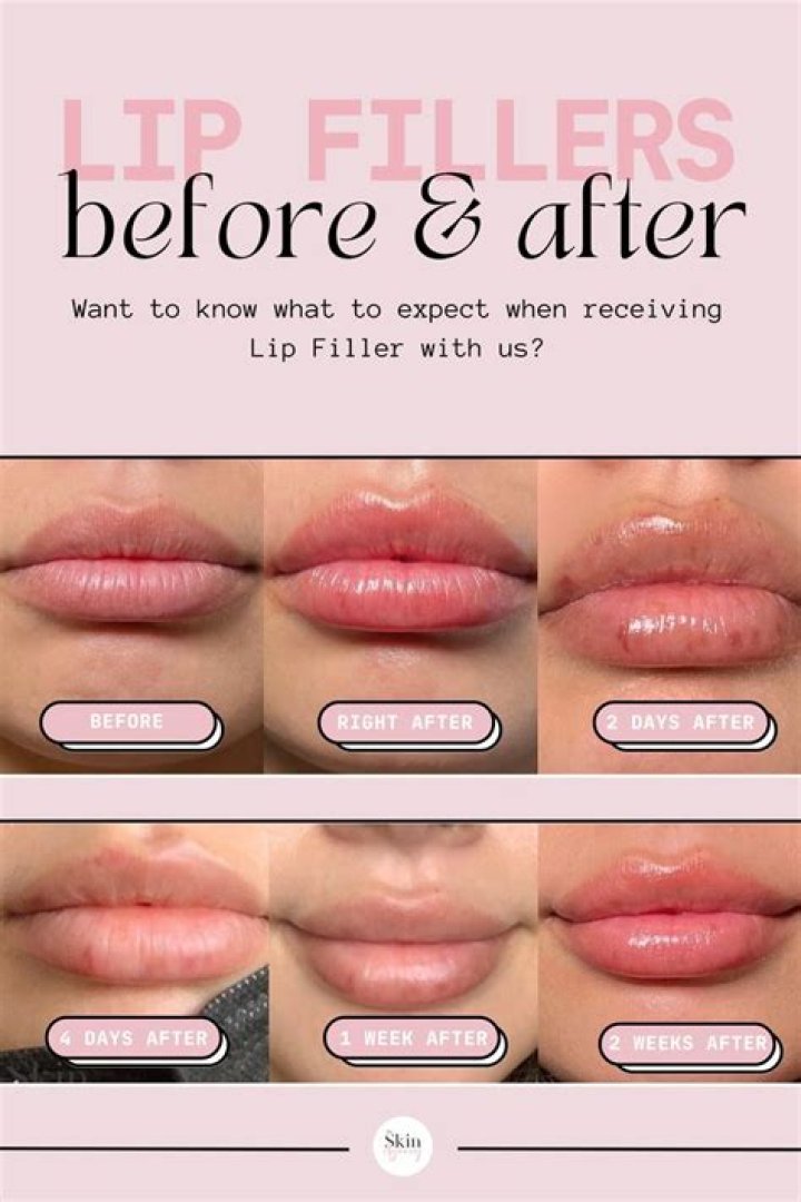 Were there lip fillers in the 80s?
