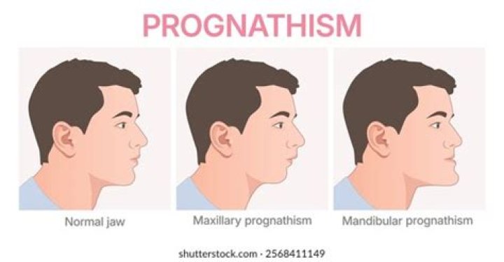 What causes mandibular prognathism?