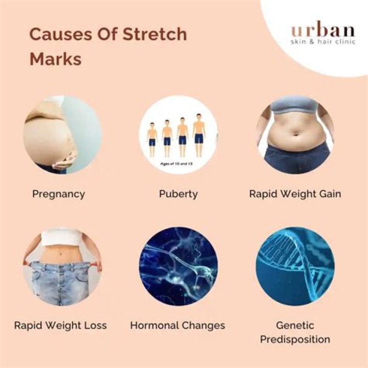 What causes stretch marks?