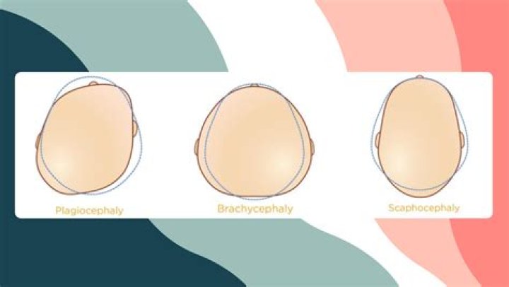 What does dolichocephaly mean?