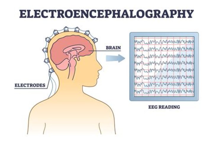 What does electroencephalographic mean?