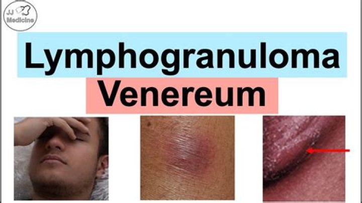 What does lymphogranuloma mean?