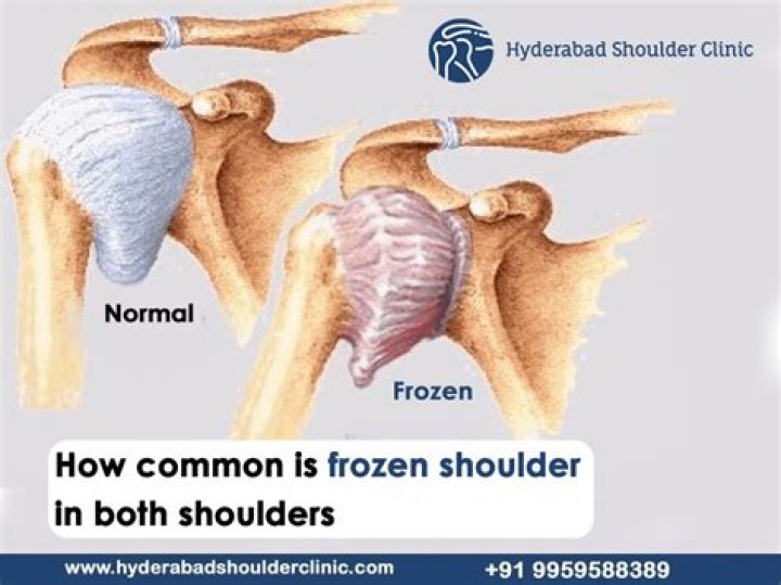 What happens when you have a frozen shoulder?