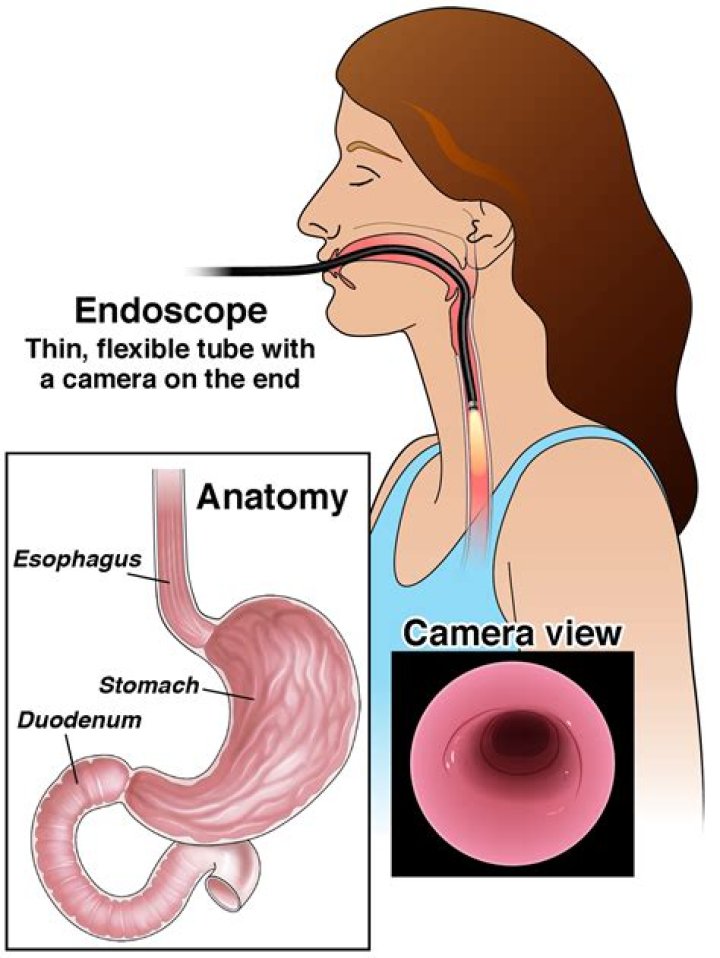 What happens when you have an endoscopy?