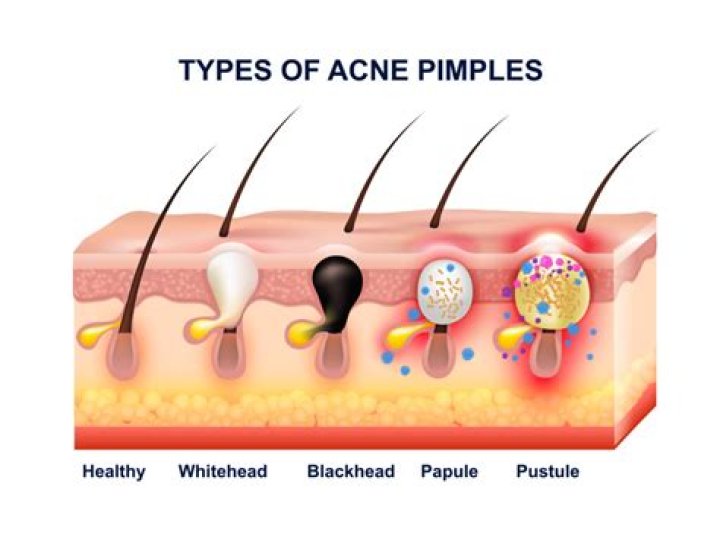 What is a sebum plug?