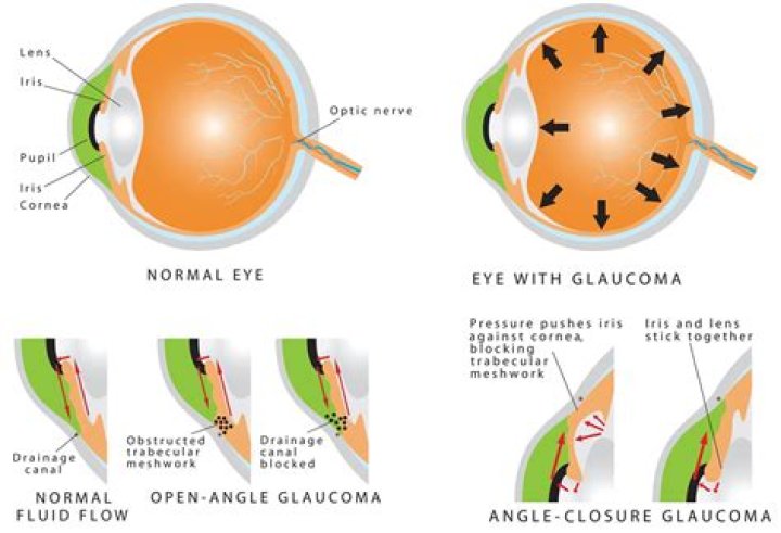 What is angle closure glaucoma?