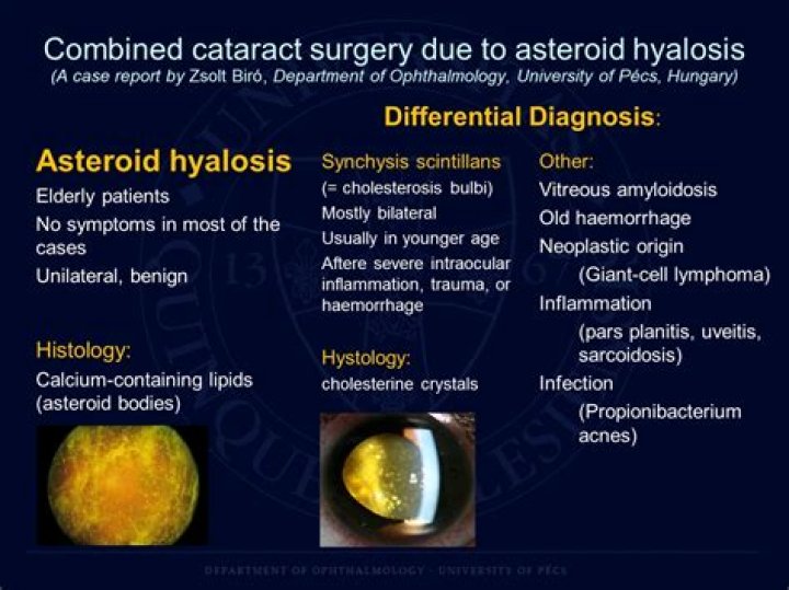 What is asteroid in medicine?