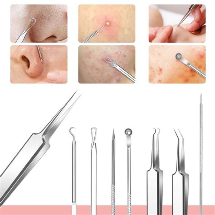 What is blackhead removal?