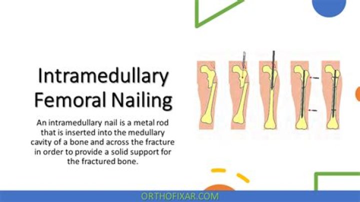 What is intramedullary nail fixation?