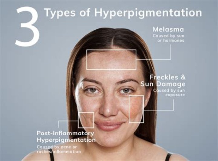 What is meant by pigmentation?