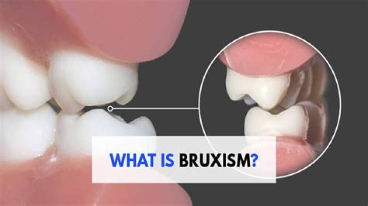 What is nocturnal bruxism?