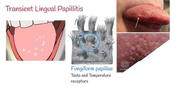 What is pigmented fungiform papillae?