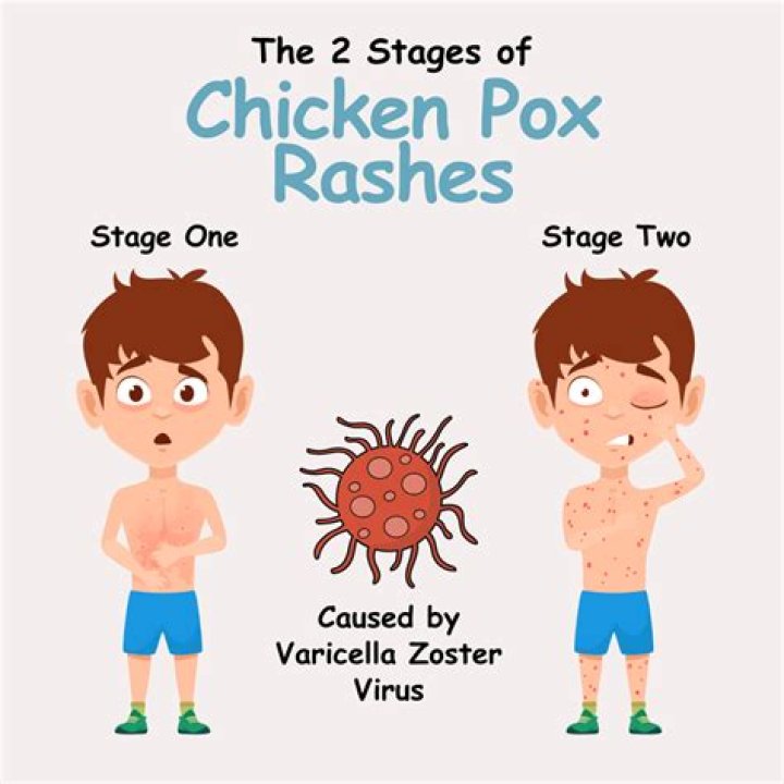 What is the incubation period for chicken pox?