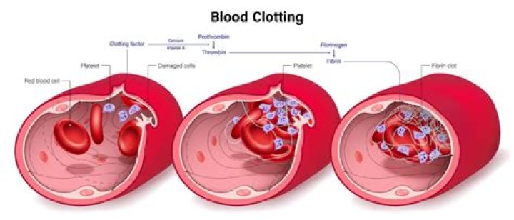 Whats a blood clotting disorder?