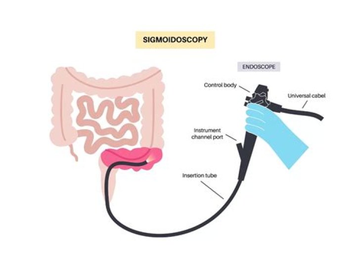 Whats a flexible sigmoidoscopy?