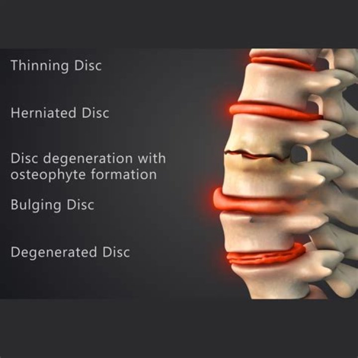 Whats the difference between bulging and herniated discs?