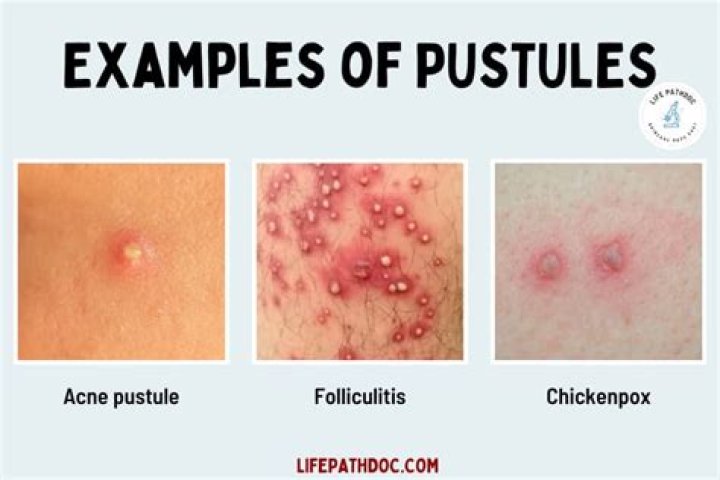 Whats the meaning of pustule?