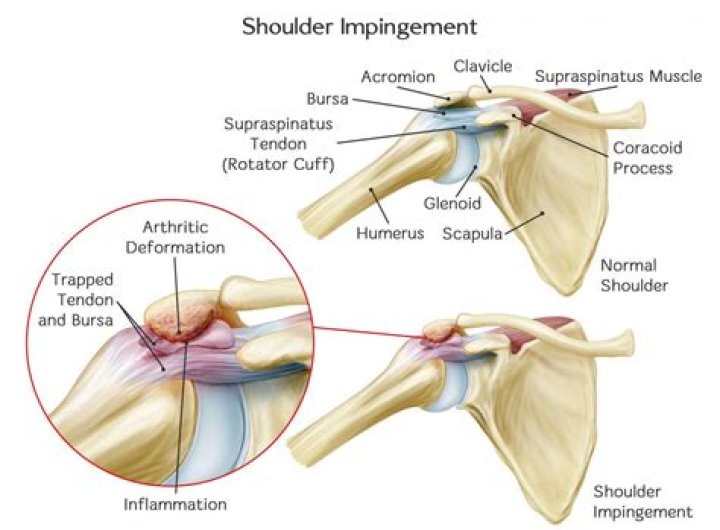When does shoulder impingement require surgery?