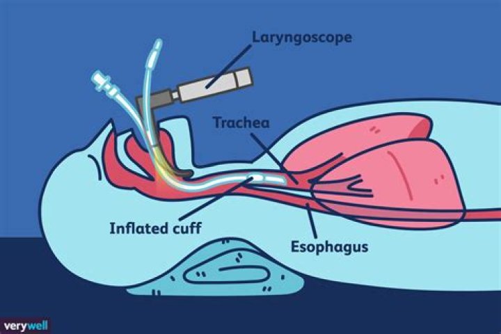 When to take laryngoscopy?