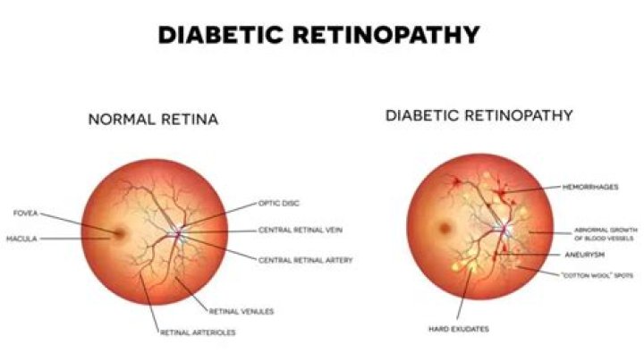 When to treat diabetic retinopathy?