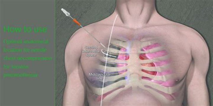 When to use a decompression needle?