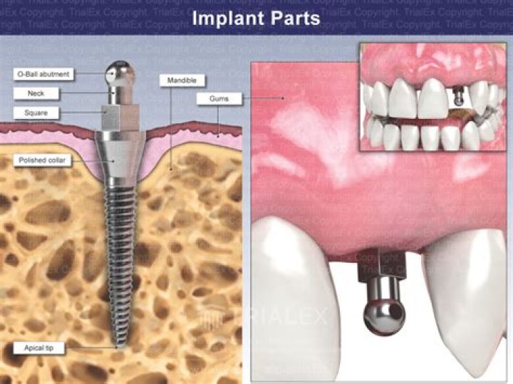 Where can I find implants?