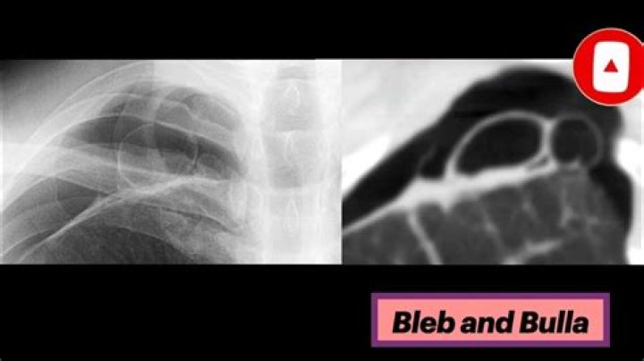 Where do lung blebs come from?