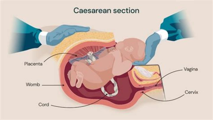 Where does cesarean section come from?