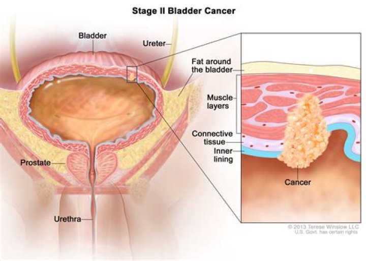 Where does urothelial cancer metastasis to?