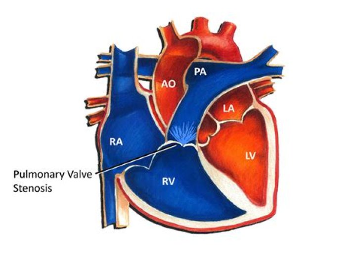 Where is pulmonic valve located?